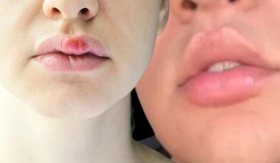 Sosyal medyada ‘evde estetik’ çılgınlığı bitmiyor… Yeni trend: Tavşan dudak! ‘Hiç akla yatkın değil, dudağı koparabilir’